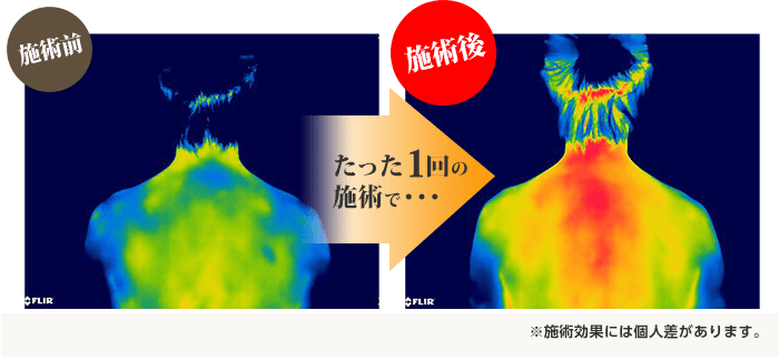 たった1回の施術で効果があります